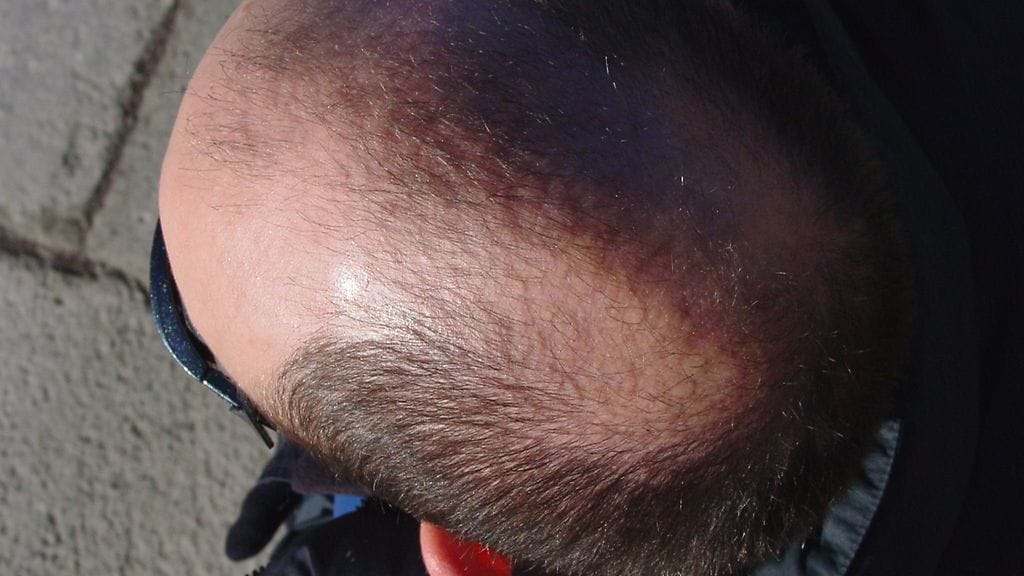 Brittimies menehtyi hiustensiirron jälkeen. Kuvituskuva.