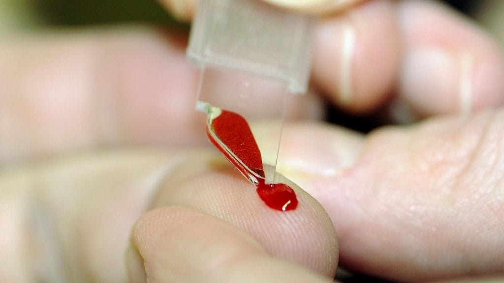 Seurannan perusteella autismin kirjon häiriöitä potevien riski sairastua tyypin 2 diabetekseen oli 3–5 kertaa suurempi kuin terveiden.