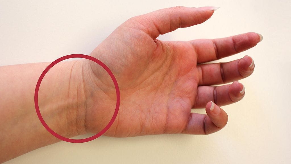 Katso, näetkö ranteessasi viivoja!