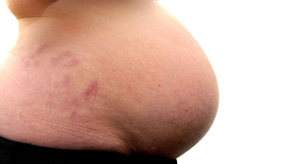 Pre-eklampsian riskitekijöitä ovat esimerkiksi verenpainetauti, äidin diabetes ennen raskautta, lihavuus sekä hedelmöityshoitojen käyttö. Kuvituskuva.