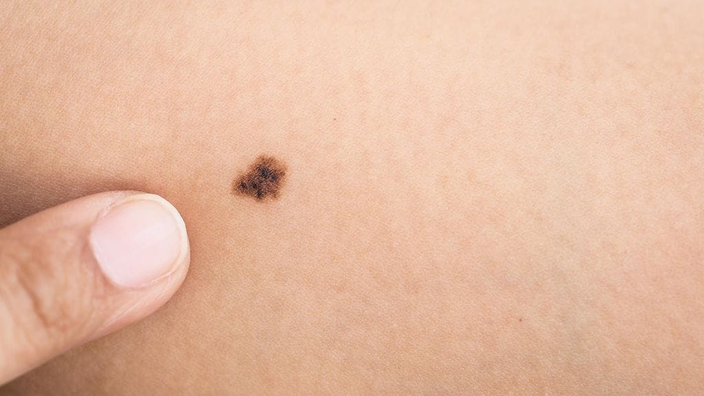 Mikäli vanhan luomen ulkomuoto tai ihollesi ilmaantunut uusi luomi epäilyttää, tarkistuta se ihotautilääkärin vastaanotolla. Kuvituskuva.