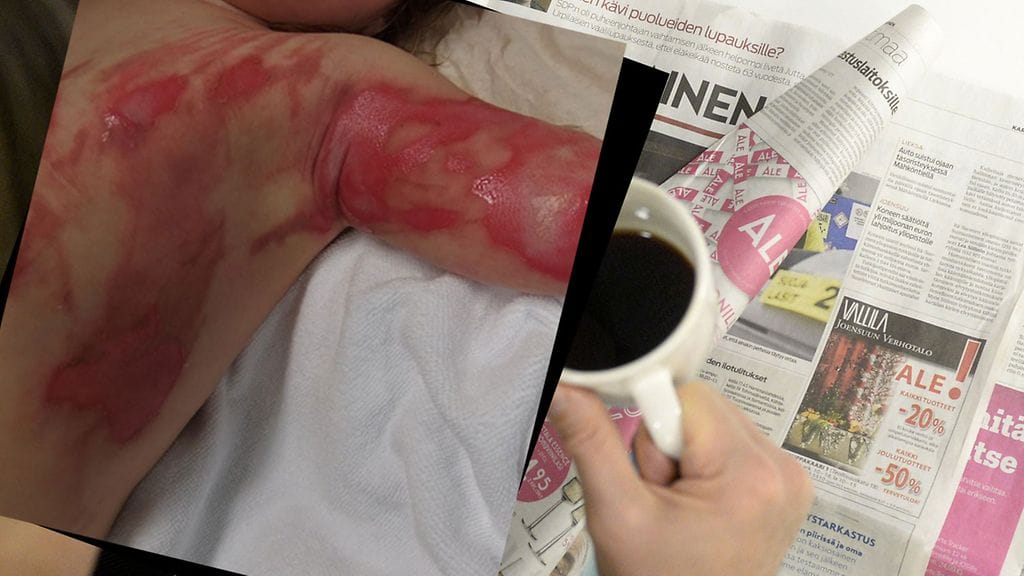 Kuuman nesteen aiheuttama palovamma lapsella. Kuva: Elina Laitakari / Lehtikuva.