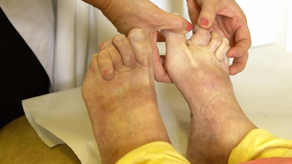 Kortisonia pidetään vaihtoehtona potilaille, joille tulehduskipulääkkeet eivät sovi. Kuvituskuva.