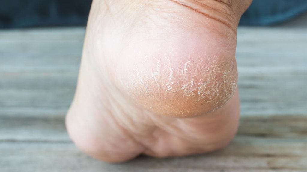 Halkeilleet kantapäät ovat yleinen vaiva.