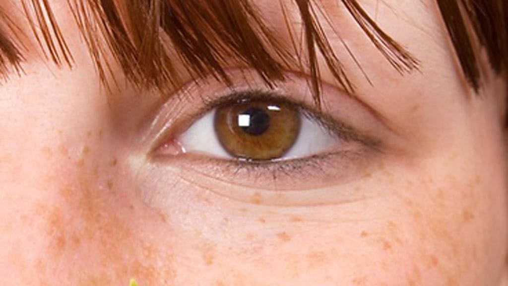 "Jos on pisamille altistava ihotyyppi, pisamia ei voi ehkäistä. Kesakoita sen sijaan voi ehkäistä järkevällä auringolta suojautumisella", lääkäri selventää.