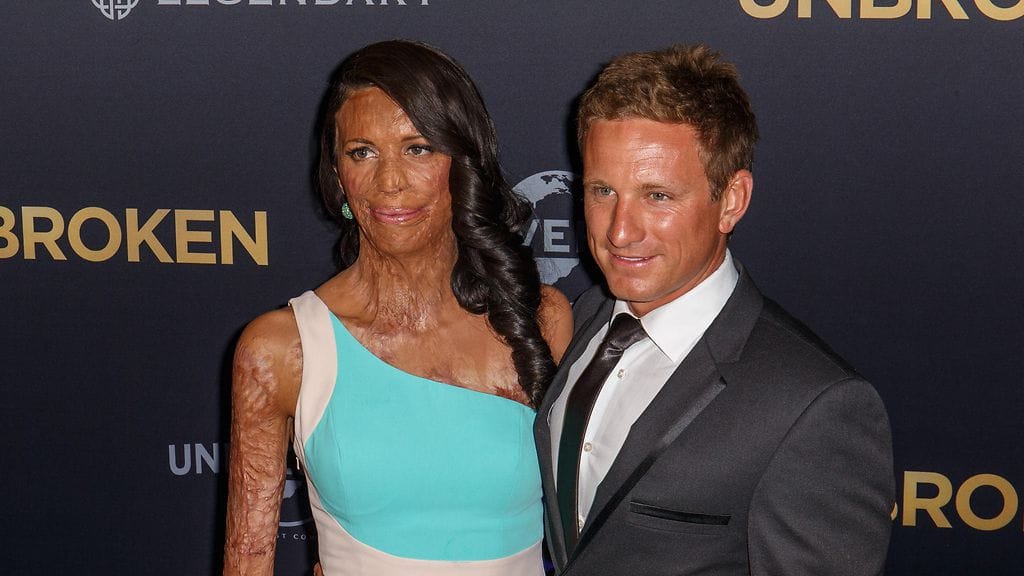 Turia Pitt ja hänen kihlattunsa Michael Hoskin ovat olleet yhdessä jo vuosia.