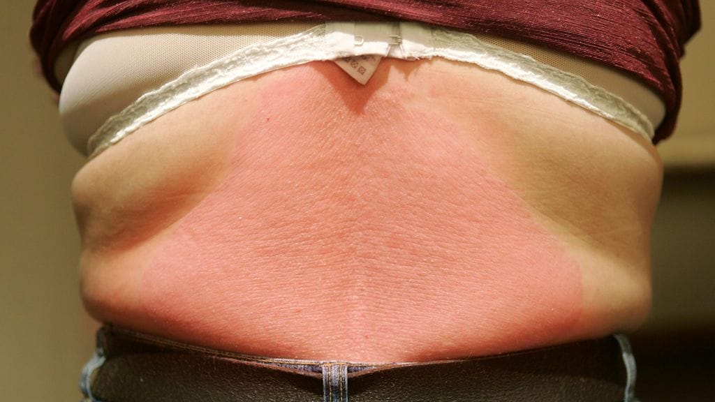 Psoriasis-ihottumaa selässä. Kuvituskuva.