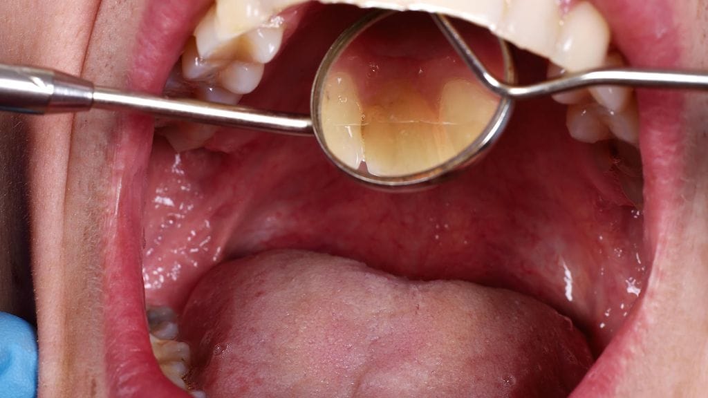 Suusyövän varhainen löytäminen on tärkeää, ja siksi hammaslääkärissä kannattaa käydä säännöllisesti. Kuvituskuva.