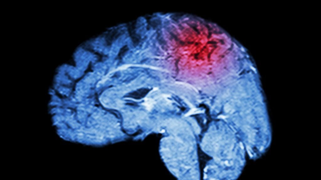 Tukoksen mekaaninen poistaminen tehosti potilaiden toipumista verrattuna verrokkeihin ja tämä näkyi vähäisempänä toimintakyvyn heikentymänä 90 päivää toimenpiteestä.