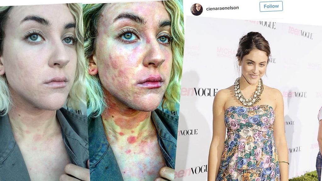 Näyttelijä haluaa kuviensa avulla muistuttaa ihmisiä psoriaasiksen vakavuudesta.