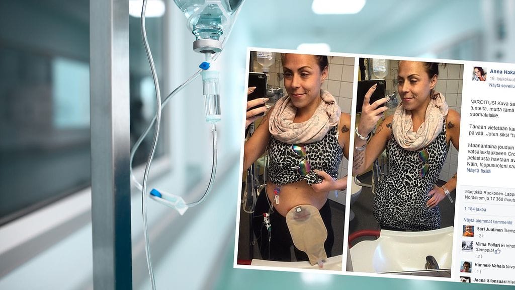 Suomessa on arviolta 6000 avanneleikattua. Suurin osa avanteista liittyy tulehduksellisiin suolistorsairauksiin.