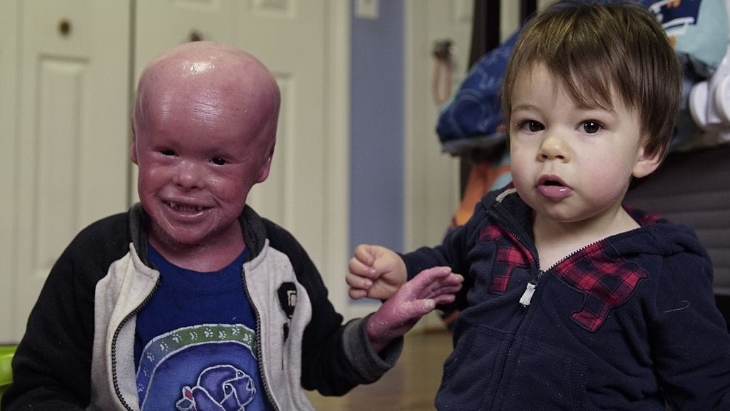 evan, harvinainen sairaus (1)