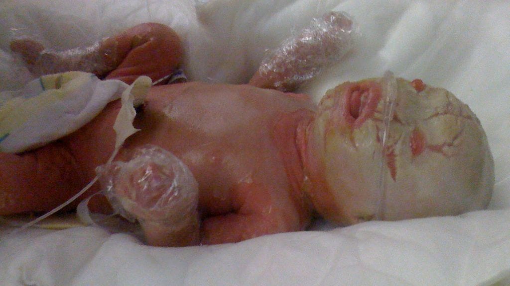 evan, harvinainen sairaus (2)