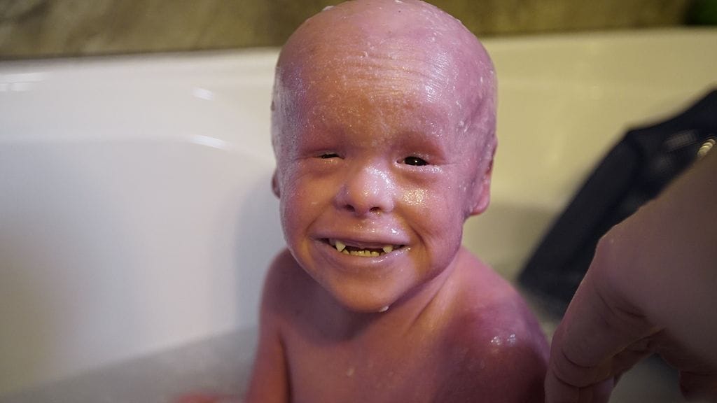 evan, harvinainen sairaus (3)