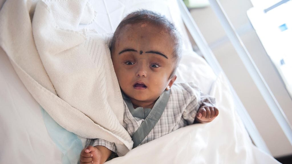 Leikkausten ansiosta pieni Roone tyttö voi istua ja nauraa.