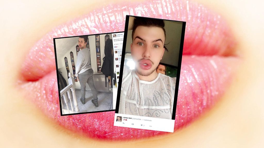 Vasta 22-vuotias Holt on käyttänyt pelkästään huuliensa täyttämiseen jo 12 000 euroa.