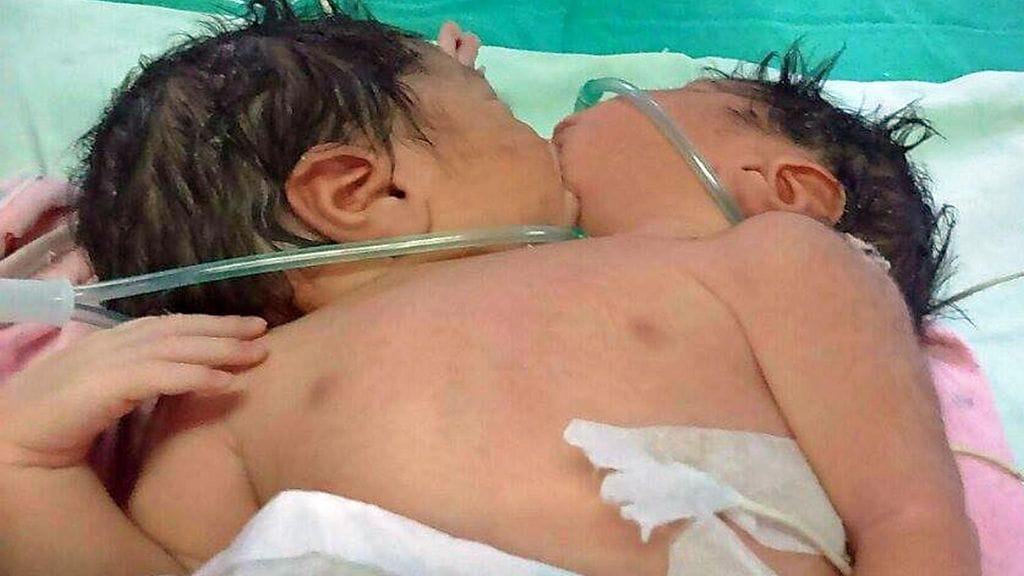 Yhteisen sydämen jakavat kaksoset aiotaan erottaa mahdollisimman pian.