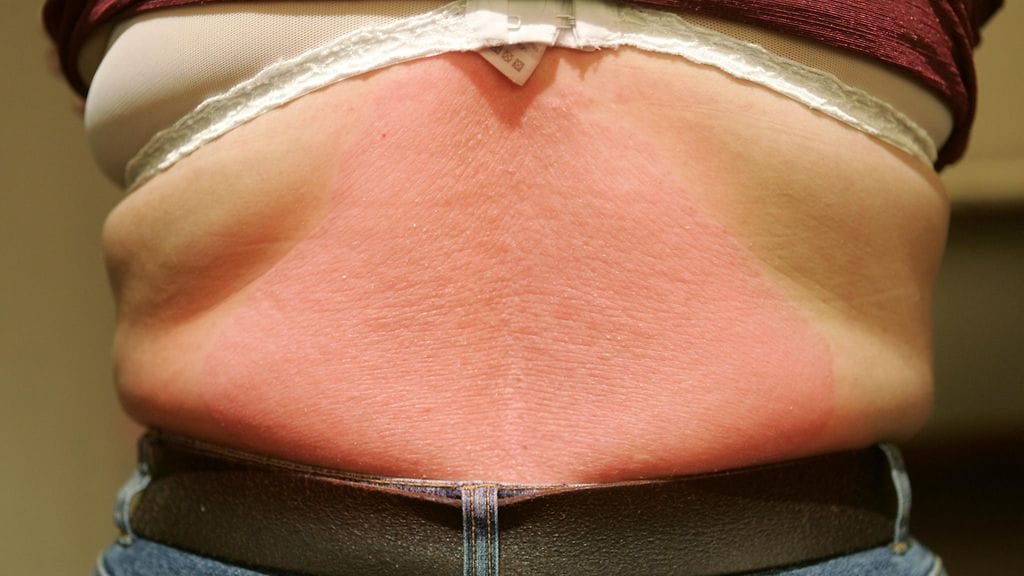 Psoriasis-ihottumaa selässä.