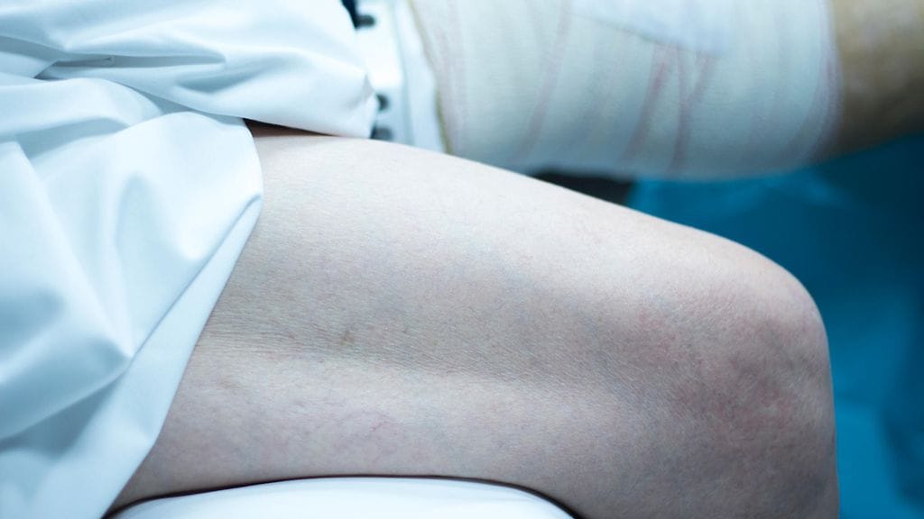 Liikunta on varteenotettava vaihtoehto polven nivelkierukkaleikkauksille.