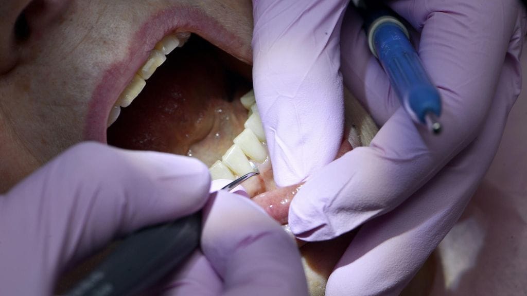 Kasvava joukko nuoria aikuisia päätyy sairaalahoitoon hammasperäisen tulehduksen vuoksi.