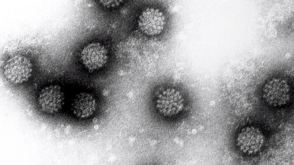 Esimerkiksi papilloomavirusinfektio voi aiheuttaa syöpää.