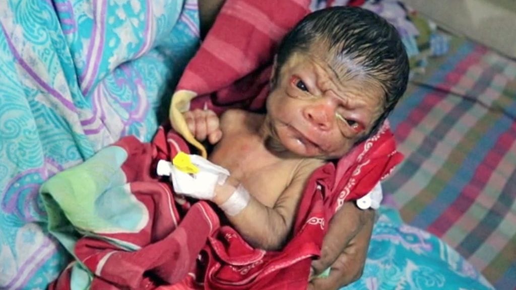 Harvinaisen mutaation aiheuttama sairaus saa lapsen vanhenemaan jopa kymmenen kertaa tavallista nopeammin.