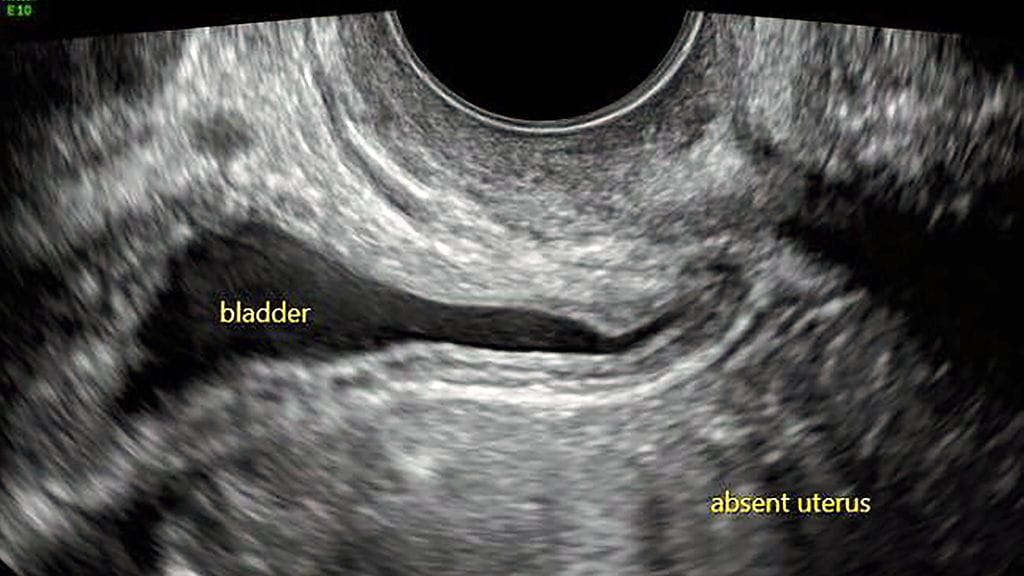 kohtu sairaus oireyhtymä