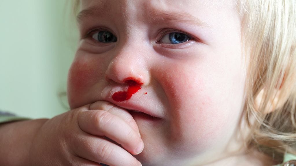 Nenäverenvuoto on hyvin yleistä 2–10-vuotiailla lapsilla.