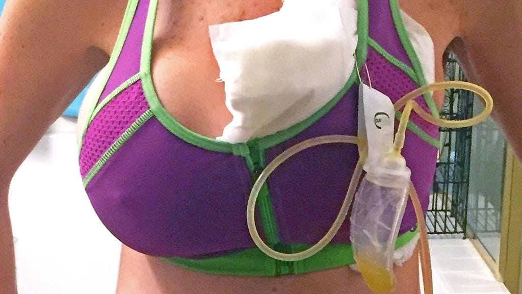 Nännilävistyksen kautta rintaan tarttunut infektio oli viedä naisen hengen.