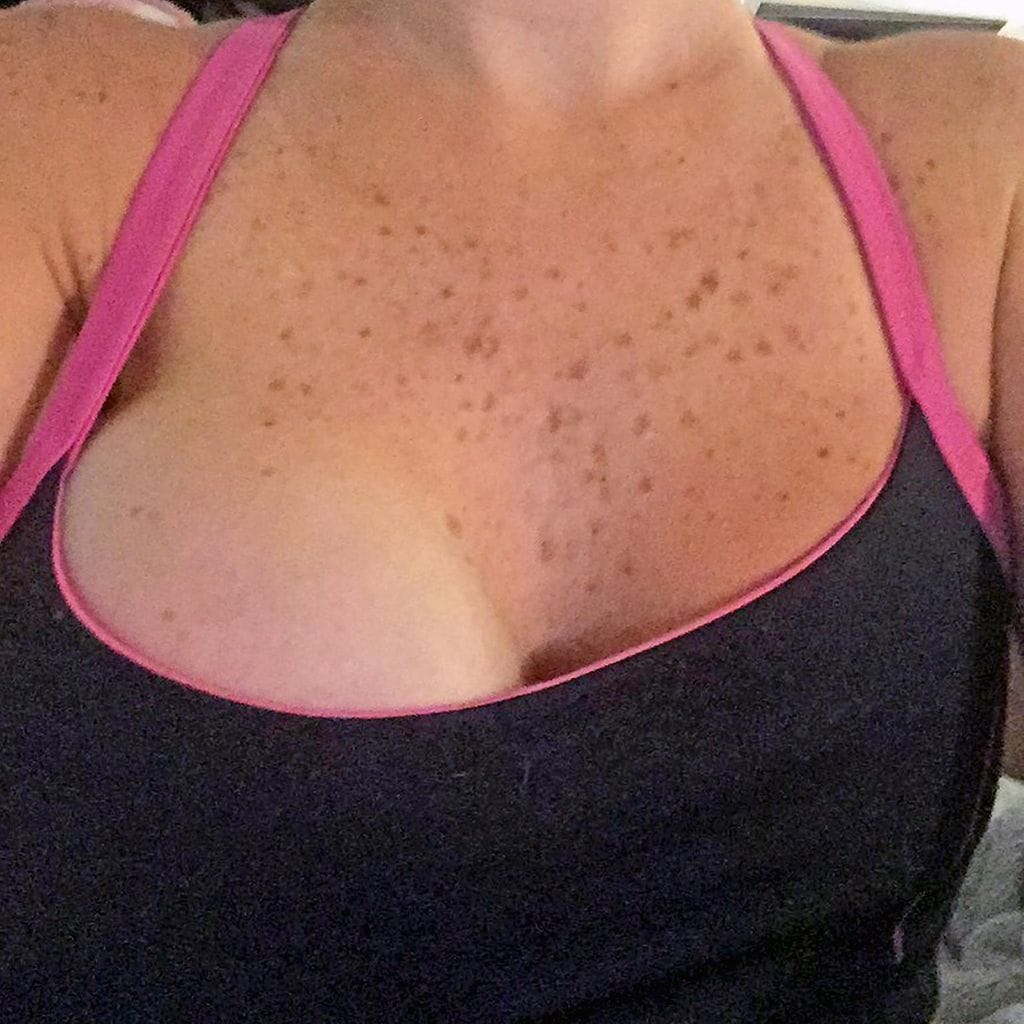 caters rintaimplantti