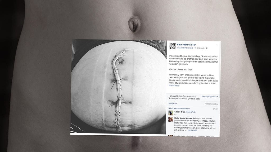 Komplikaatioiden vuoksi tuoreen äidin vatsaa koristaa nyt tavallista suurempi leikkausarpi.