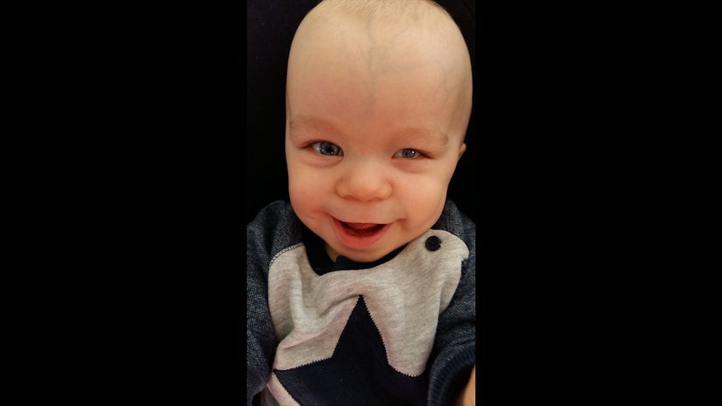 Rasmukselle todettiin synnynnäinen pienisilmäisyys, mikroftalmia ja kolobooma vasemmassa silmässä.