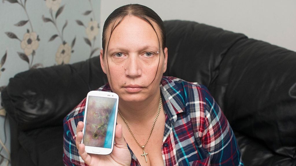 Hyönteisen purema aiheutti Tracey Bortoftin jalkaan palovamman kaltaisia rakkuloita.