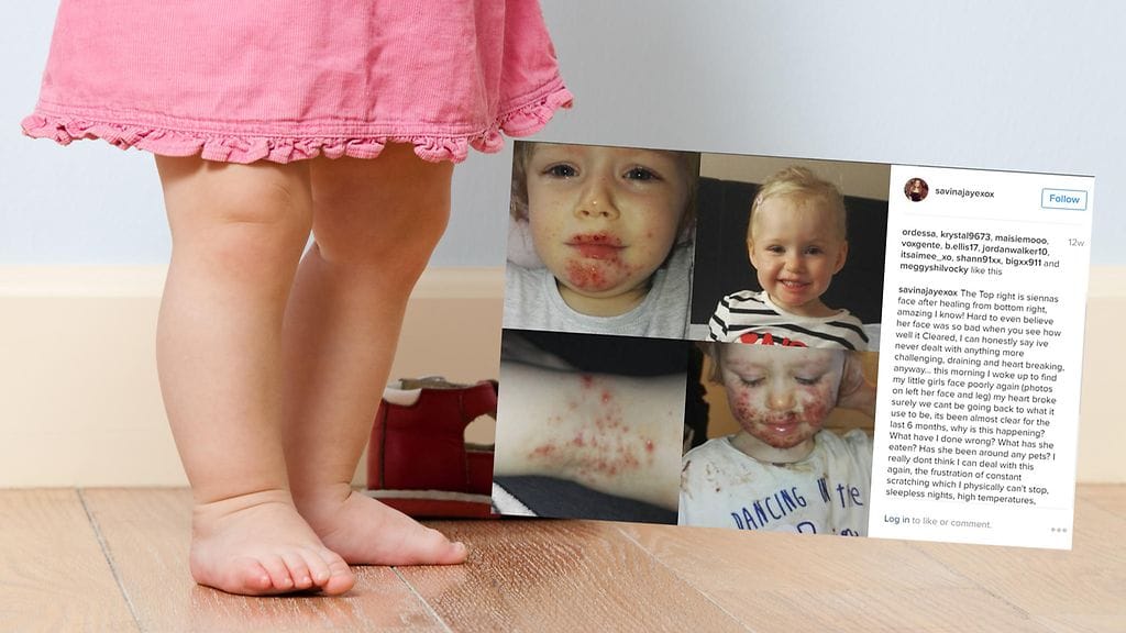 Tyttö joutui kärsimään oireista useamman kuukauden, ennen kuin toimiva hoitokeino löydettiin.