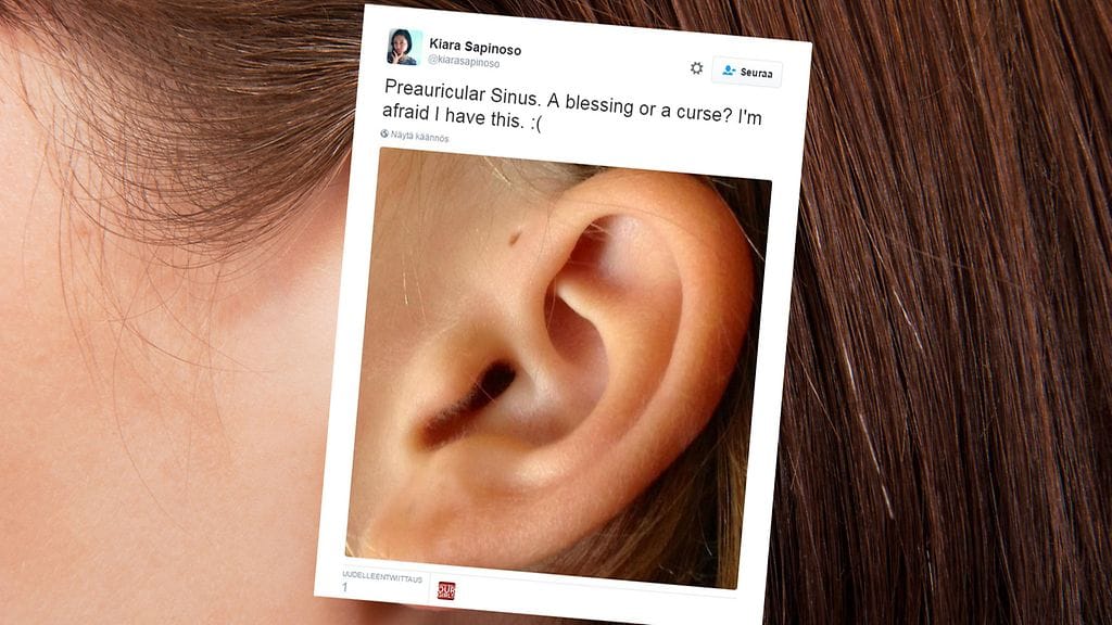 Eurooppalaisesta väestöstä alle yhdeksällä prosentilla on pieni reikä korvansa ulkopuolella.