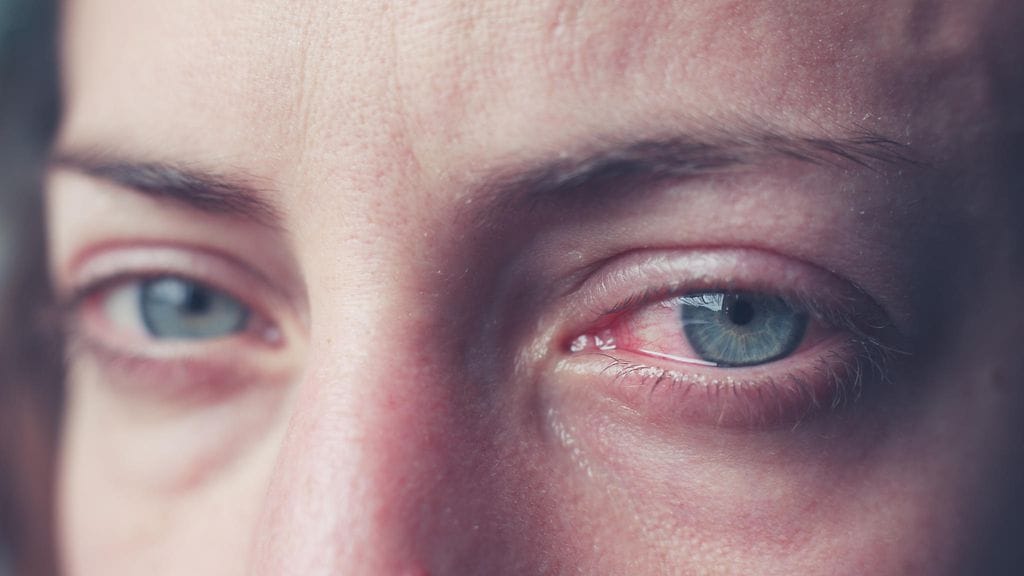 Punoittavien silmien taustalla on usein tulehdus, joka saa silmäsi punaisen näköisiksi.