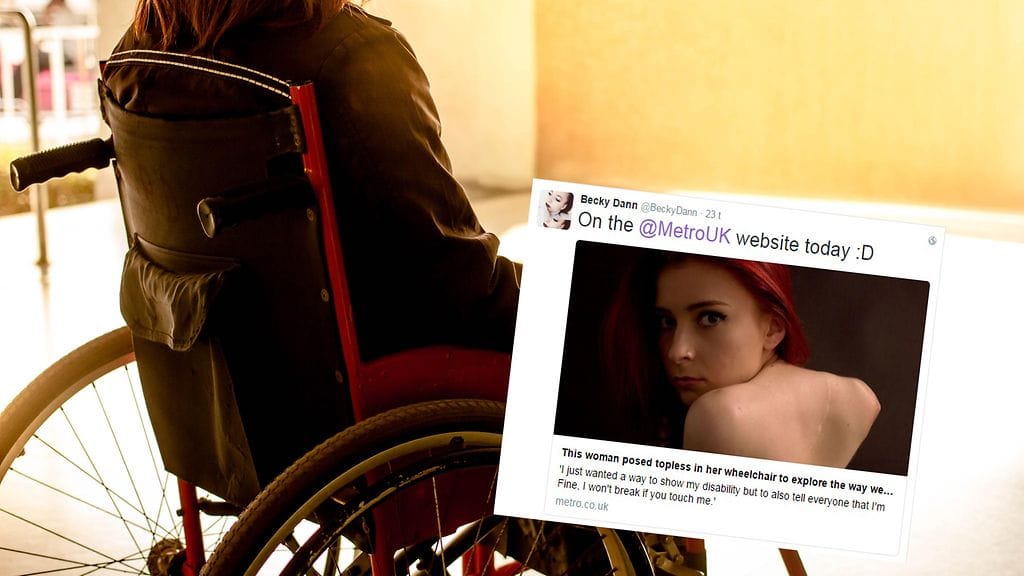 Yläosattomissa poseerannut nainen toivoo, että ihmiset osaisivat katsoa häntä vammaa pidemmälle.