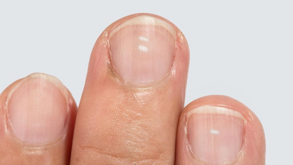 Onko nämä merkit tuttuja omissa kynsissäsi?