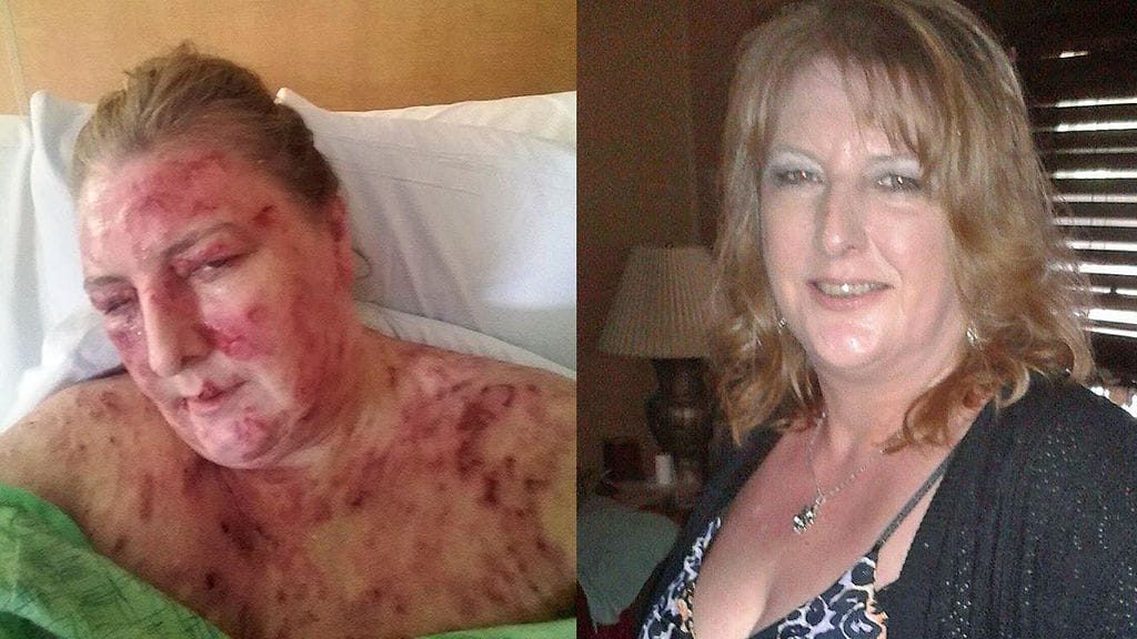 Amerikkalainen Cathy Garza, 51, joutui kärsimään hyvin harvinaisesta syövästä.