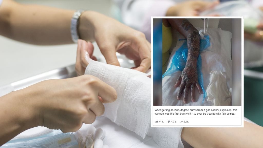 Tulevaisuudessa palovammat saatetaan hoitaa kalannahan avulla.