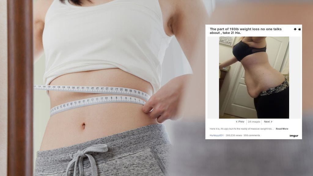 Löysä iho on asia, josta hurjasti laihtuneen naisen mukaan hyvin harva puhuu avoimesti.