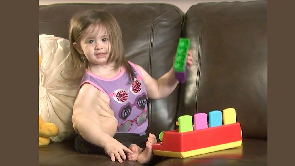 Madison Gatlinin oikean käsivarren turvotus on lisääntynyt syntymästä saakka.