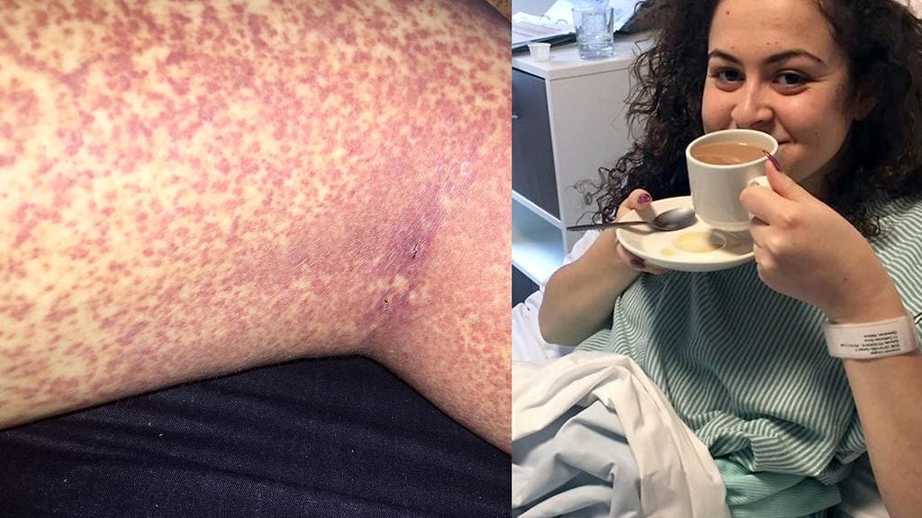 Vasemmalla Rhiannonin ihottuma. Oikealla Rhiannon sairaalassa.