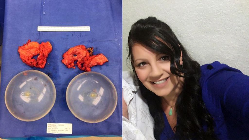 Homeiset implantit ja niiden vuoksi kärsinyt Dee Hicks, 45.