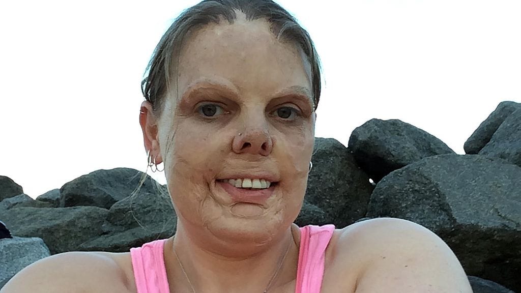 Tammie leikkauksen jälkeen