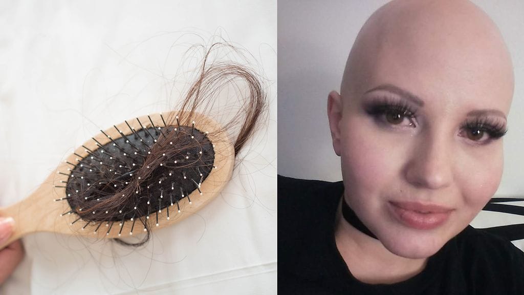 Autoimmuunisairaus alopeciaan sairastunut Laura Hämäläinen on joutunut etsimään omakuvaansa uudelleen.