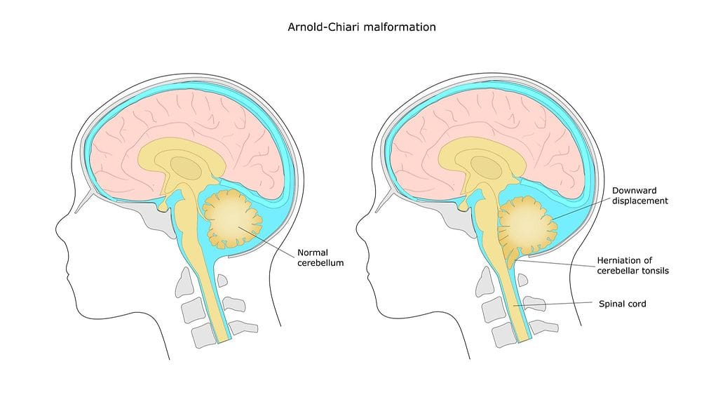 arnold-chiari