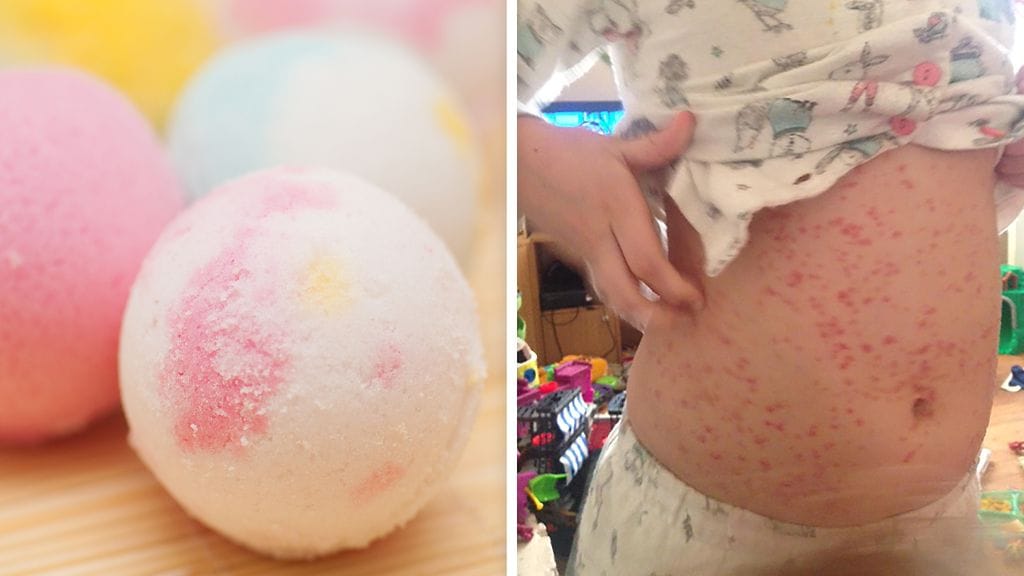 Kylpypallojen käytöstä aiheutunut ihottuma on levinnyt tytön koko kehoon.