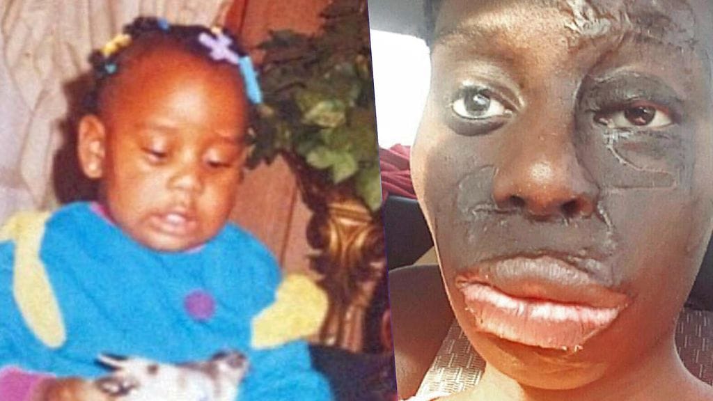 Kuvassa Alyssa ennen paloa, sekä aikuisena.