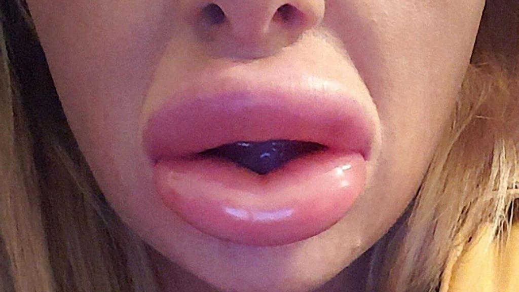 Omalleyn huulet operaation jälkeen.